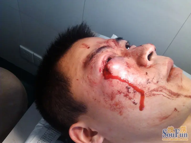 畔雅苑物业验房时重伤业主,致使眼部缝合20余针!